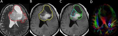 Factors Associated With Dysfunction of Glymphatic System in Patients With Glioma